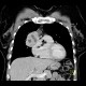 Mediastinal metastasis of malignant melanoma: CT - Computed tomography